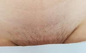 Study of laser hair removal photos can give you a better idea about the results of hair removal surgery. Before And After Hair Removal Results Clhr