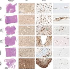 But there is a limited time in which. Neuropathology Of Patients With Covid 19 In Germany A Post Mortem Case Series The Lancet Neurology