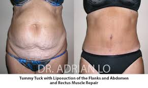 Image result for Liposuction