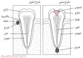 خراج الاسنان Tooth Abscess طبيب دوت كوم