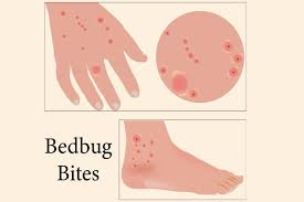 Bed Bug Bites On Kids Picture Causes Treatment Remedies