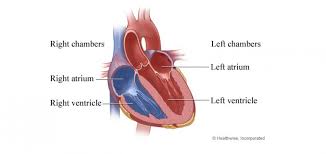 Image result for Ventricular Septal Defect