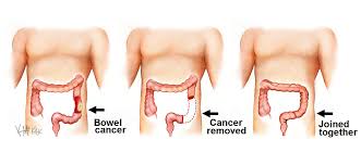 It is very possible for an individual to think they have a very minor health issue when in fact, they could be experiencing early. Bowel Cancer Colorectal Surgeons Sydney