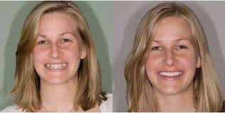 Emily Cheeseman's finally got adult teeth