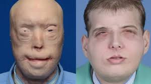 US firefighter has world's most extensive face transplant