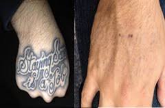 For over 15 years, we have been helping aestheticians, nurses, and physicians achieve clinical competency in the use of aesthetic lasers. Laser Tattoo Removal Miami Laser Tattoo Removal