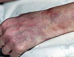 § другие спирохетозы (болезнь лайма, лептоспироз). Uzelkovyj Periarteriit Simptomy I Lechenie Diagnostika I Klassifikaciya Xmedicin