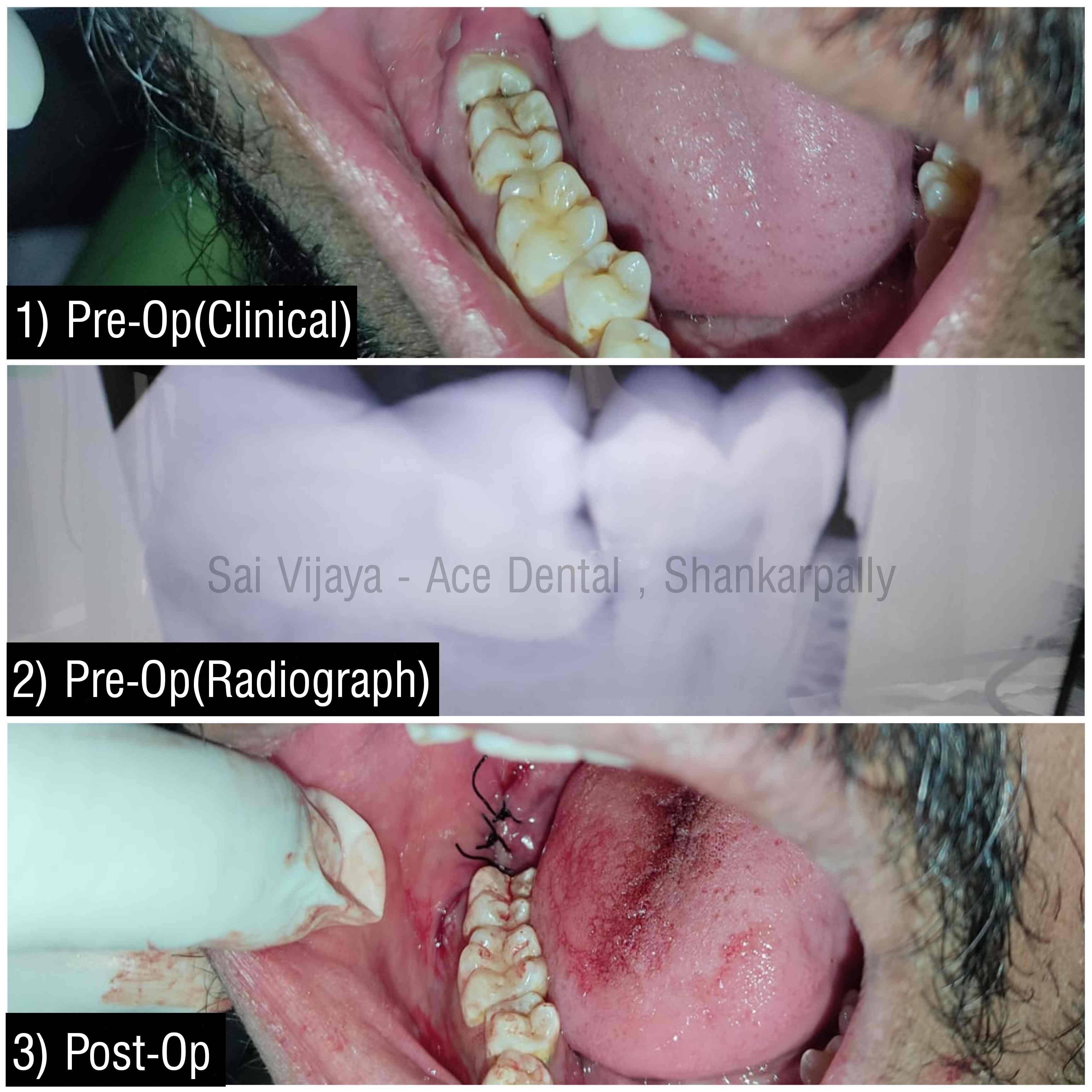 Horizontally Placed 3rd Molar product image
