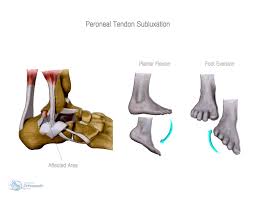 Layer i is the deep crural fascia which is in continuity with the medial patellar retinaculum and the sartorial fascia. Peroneal Tendon Problems Orthopaedic Adam Budgen