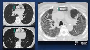Usf Doctor Warns Covid Can Severely Damage Lungs Even In Those Without Symptoms