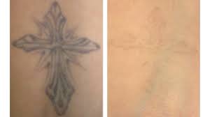 Suzanne yee, md, f.a.c.s., offers laser tattoo removal at her little rock, ar, practice. Tattoo Removal How To Costs Before And After Pictures More