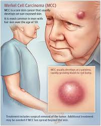 Merkel cell carcinoma (mcc) is a rare and aggressive skin cancer occurring in about 3 people per 1,000,000 members of the population. Merkel Cell Carcinoma Jama Dermatology X Mol