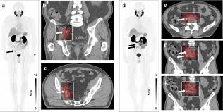 As with brachytherapy, this may not be a good option for men with large prostate glands. Patterns Of Progression After 68ga Psma Ligand Pet Ct Guided Radiation Therapy For Recurrent Prostate Cancer International Journal Of Radiation Oncology Biology Physics