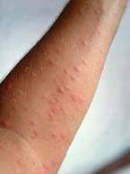 L'interesse che ruota intorno alla tematica ha registrato negli ultimi anni un aumento costante, non soltanto da parte di medici e studiosi ma anche di tutti i profili che operano e interagiscono nel settore dell'alimentazione. Allerta Processionaria