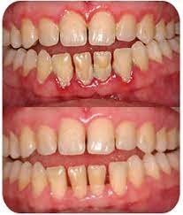 Gum Disease Treatment In Nashville - Modular Periodontal Therapy For Oral  Health - Periodontal Disease | Beam Smile Design - Cosmetic & General  Dentistry