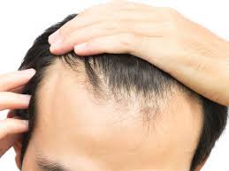 Cobalamin or vitamin b12 produces red blood cells in your bloodstream. Hair Falling Out And Vitamin Deficiency