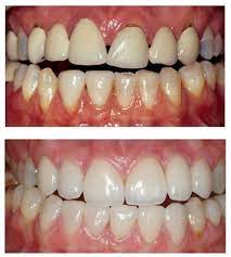 Safe Dental Bridge Mouths Toothpaste Dentalbridgeother Dental Bridge Cost Cosmetic Dentistry Dental Bridge