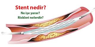 Damarlarda ya da kalpte bir sıkıntı görülsün ya da görülmesin kişilerin. Stent Nedir Nasil Takilir Hangi Hastalara Uygulanir Riskleri Nelerdir