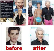 Check spelling or type a new query. Rodrigo Alves Rib Removal Surgery Botchedsurgeries