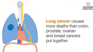 Learn more about the causes and risk factors for lung cancer. Lung Cancer Causes Symptoms And Treatment