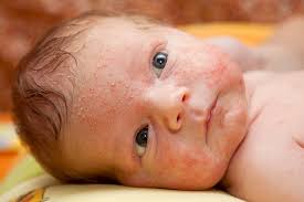 Als eltern von babys mit neurodermitis dreht sich gefühlt 24/7 alles um die geplagte haut unseres schützlings. Neugeborenenakne Hautveranderungen So Sehen Neugeborene Aus Das Neugeborene Medizinisches Baby Swissmom Ch