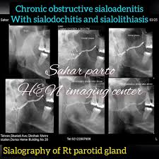Image result for Sialoadenitis