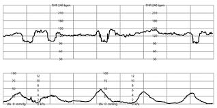 Intrapartum Fetal Monitoring American Family Physician