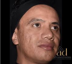 Remodelación de Cicatrices con Láser CO2 en Bogotá