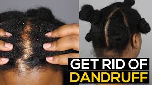 How To Get Rid Of Dandruff Permanently Fast Ammina Rose Youtube