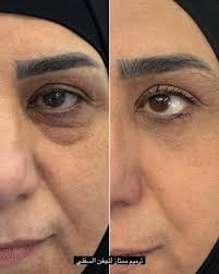 Droopy eyelids or tired eyes can affect your appearance and confidence.  Oculoplasty and blepharoplasty offer effective solutions to correct eyelid  imperfections and refresh the eye area. With Dr. Mohamed Abdel Hafez at