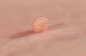 If you notice that a mole has grown back, see your doctor promptly. Skin Tag Removal Why You Shouldn T Diy Health Essentials From Cleveland Clinic