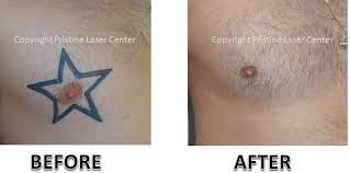 Here's what you should know before booking a tattoo removal if you've heard anything about laser tattoo removal, it's probably along the lines of it being insanely painful, like maybe even more than getting the tattoo. Before And After Laser Tattoo Removal Orlando Pristine Laser Center Pristine Laser Center Orlando