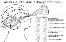 Image result for Visual Field Deficit