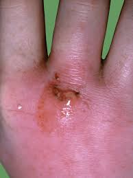 Image result for Septic Joint