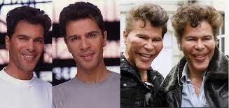 These Photos Are Of Those Celebrities Who Ruin Their Faces They Ruin Thier Faces With Plastic Plastic Surgery Plastic Surgery Gone Wrong Plastic Surgery Fail