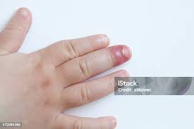 Image result for Akutní zánět nehtového lůžka