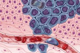 Informasjon og råd om symptomer, forebygging, undersøkelser, behandling og livet etter kreft. Kreft Store Medisinske Leksikon