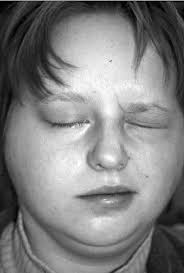 The 3rd day after hospitalization: facial nerve palsy occurred