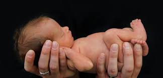 Image result for paralysis in newborn babies