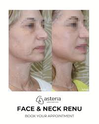 THREAD LIFT NON SURGICAL PROMO!!! Purchase your voucher before 31/05/2020  and have your procedure done any time until 31/12/2020!!! Look years  younger with non-surgical thread lifts. MINIMAL DOWNTIME! Contact us-012  998 4486