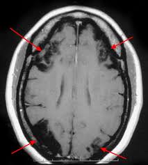Moyamoya Disease Causes Symptoms Life Expectancy Treatment