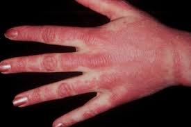 Mechanic S Hands In A Patient With Dermatomyositis Image Reprinted Download Scientific Diagram The symptoms of dermatomyositis are similar to those of polymyositis, but there's also a distinctive rash.