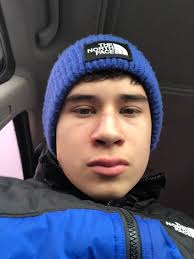 Nose Collapse from Broken Nose