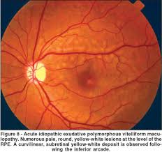 Arquivos Brasileiros De Oftalmologia The White Dot Syndromes