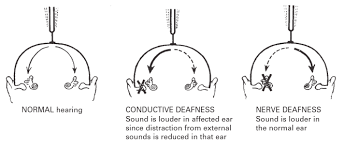 Understanding The Types Of Deafness Comparison Diagram Deaf Deaf Ear Sound Talk To The Hand