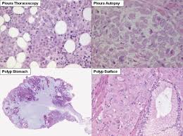 For the cancerous cells found in the tumors: Epithelioid Mesothelioma At Diagnosis In Pleura At Autopsy In Pleura Download Scientific Diagram