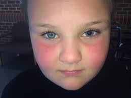 Child's head injury from peewee football