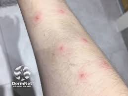 Image result for Pathergy