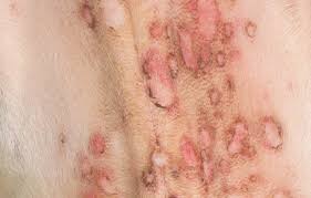 Lesions can also affect the. How To Recognize Autoimmune Skin Disease Tips For Spotting Pemphigus Foliaceus