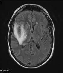Gray matter is predominantly affected (cognitive / psychiatric signs, lethargy, seizure). Encephalitis Ct Scan Radiopaedia Ct Scan Machine
